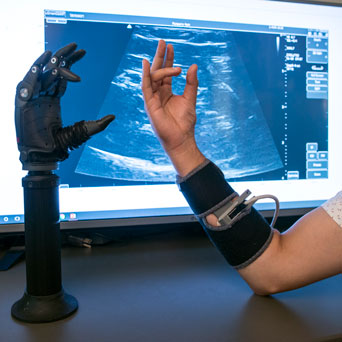 Researchers work on a prosthetic arm that uses ultrasound to move.
