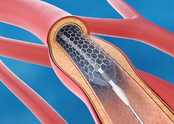 graphic depiction of stent in a vein